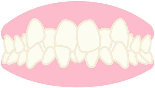 Occlusion Dentaire Naturelle ou Prothétique - Les Bases de Notre Santé