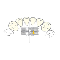 Vector 100 mini - Vérin Orthodontique Scheu Dental