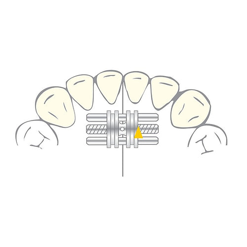 Vector 100 Mini - Vérin Orthodontique - Scheu Dental - Acier Inox 10 U