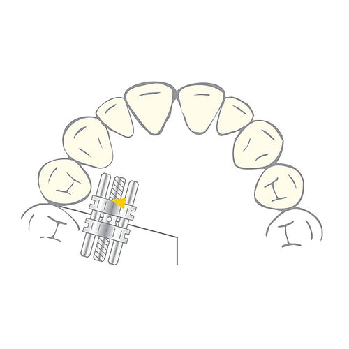 Vector 140 - Vérin Orthodontique Scheu Dental - Acier Inox - 10 Pièces