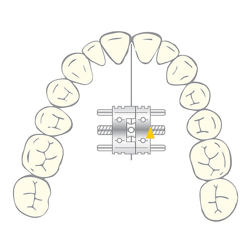 Vector 200 Mini - Vérin Orthodontique - Scheu Dental - Acier Inox 10 U