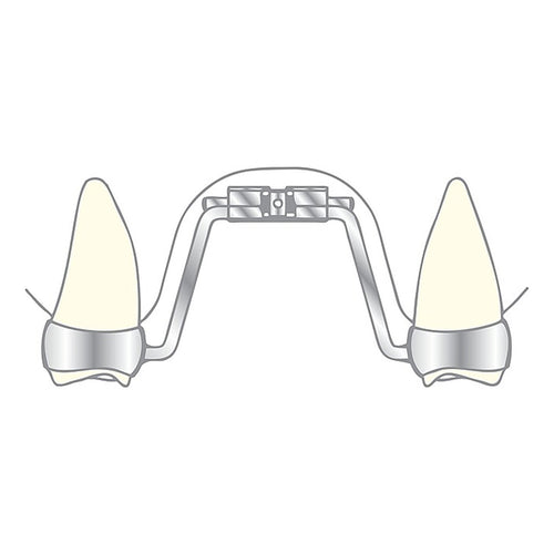 Vector 600 - Vérin Expansion Palatine  Scheu Dental - Double Bras - 1U