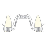 Vector 600 - Cilindro de expansión Palatina Scheu Dental
